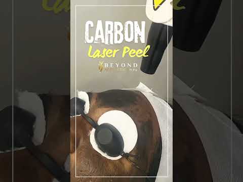 Carbon Laser Peel | Beyond Aesthetic Clinic