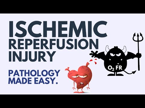 Ischemic Reperfusion Injury Pathology - Explained Simply (2024)