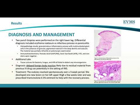 Thumbnail image of video presentation for Granulomatous Foreign Body Reaction in the Setting of Immune Reconstitution Inflammatory Syndrome