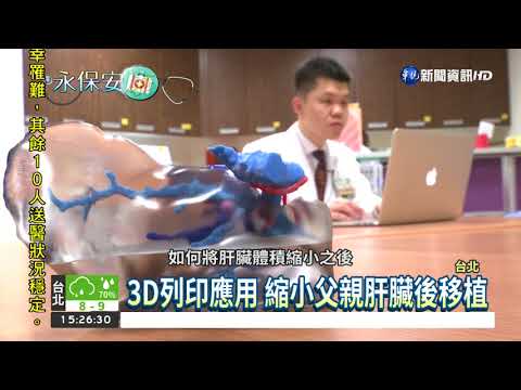 3D列印應用 完成罕病肝移植手術