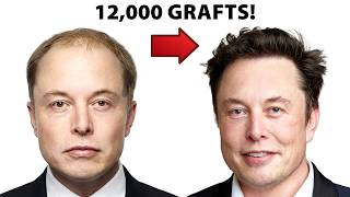 Have Hair Transplant Gigasessions Gone TOO FAR?