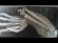 A Boy Ate 150 Gummy Vitamins For Breakfast. This Is What Happened To His Bones.