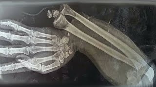 A Boy Ate 150 Gummy Vitamins For Breakfast. This Is What Happened To His Bones.