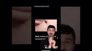 #dermreacts belly button #blackhead. #pimplepopping #skincare #shorts