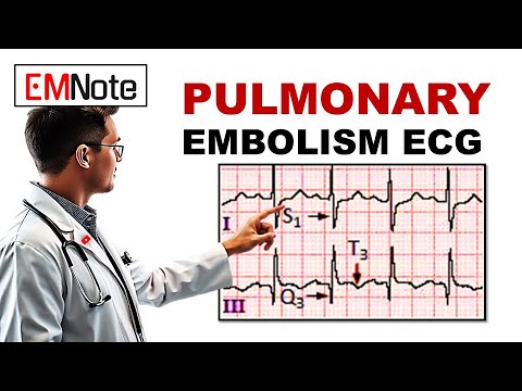ECG Changes in Pulmonary Embolism
