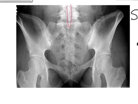 Sacrum, Coccyx, and SI Joints