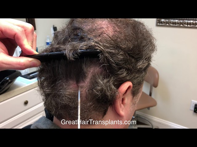 Dr. Brett Bolton Patient Toby  MaxHarvest&trade;
