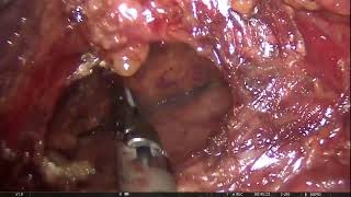 Download Lagu Laparoscopic Frykman-Goldberg for Internal Rectal Prolapse and Chronic Constipation Thumbnail
