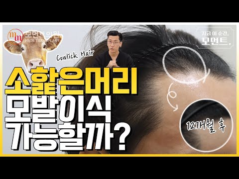 소핥은머리 모발이식 가능할까 ❓???? (카우릭헤어) l 김경복원장 l 모먼트의원(MOMENT) l 히든컷