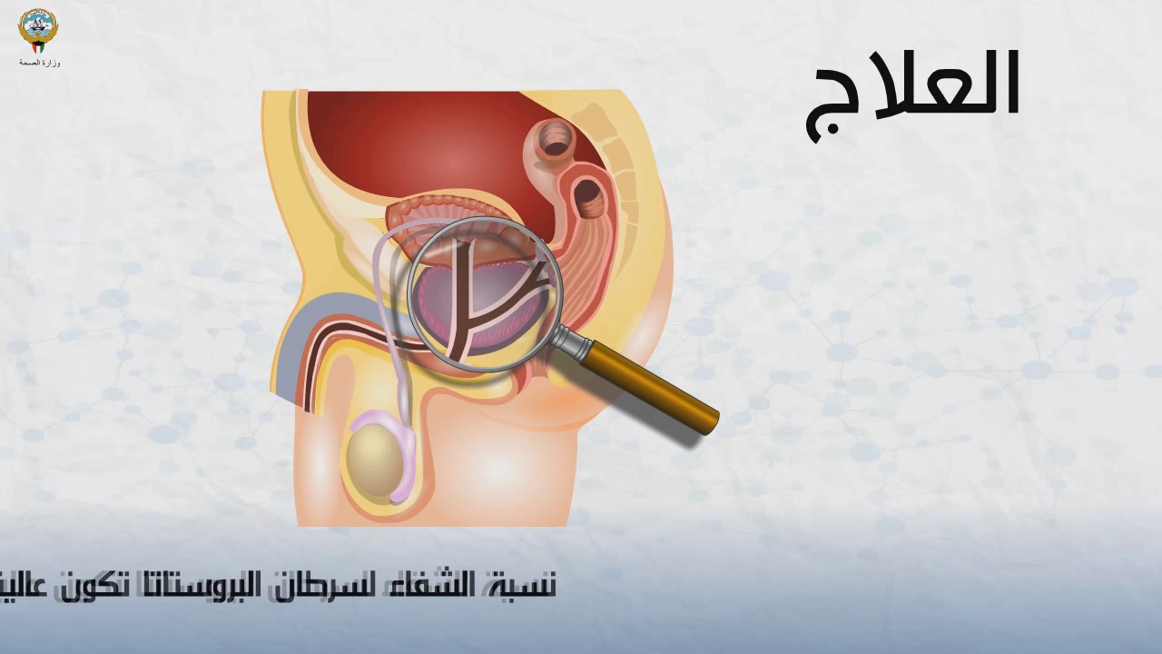 سرطان البروستاتا #العلاج والاكتشاف المبكّر