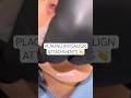 Watch as Dr. Ravi places Invisalign attachments 👏 #ruhdental #invisalign
