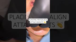 Watch as Dr. Ravi places Invisalign attachments 👏 #ruhdental #invisalign