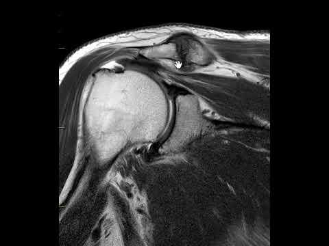 Rotator cuff tear | First Look MRI