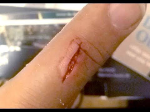 30 days wound healing time lapse