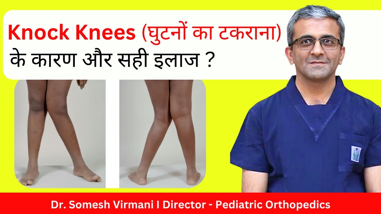 Knock Knees क्यों होता है? क्या है इसका कारण और सही इलाज?✅| Knock Knees | Dr. Somesh Virmani