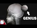 How a Baseball Injury Made A Genius (Savant Syndrome)