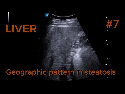 Liver Steatosis with Geographic Pattern video preview