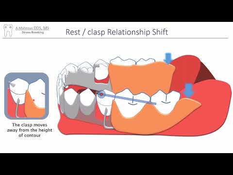 RPD Stress Breaking in 5 mins