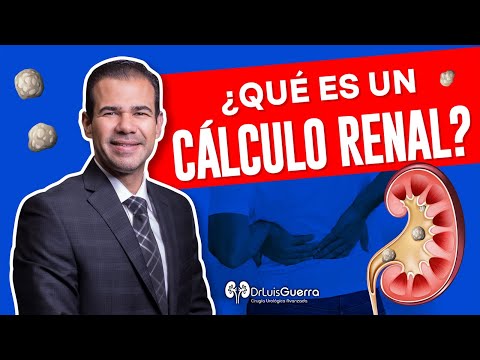 Cálculos Renales – Síntomas y Causas