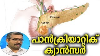 Dr Q: പാന്‍ക്രിയാറ്റിക് ക്യാന്‍സര്‍ | Pancreatic Cancer | 25th February 2019