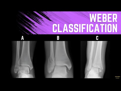 Weber Classification (Ankle Fractures)