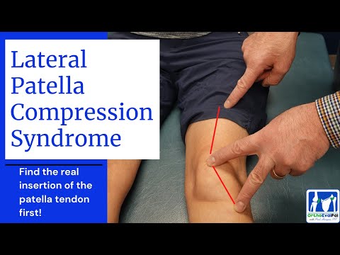 Quadriceps Repair 3 Weeks Post Op