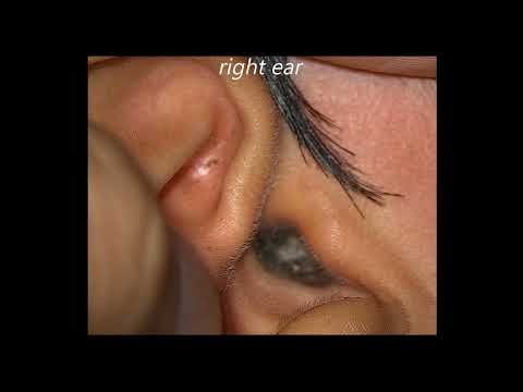 Earwax Impaction In Both Ears