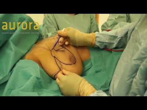 両側乳房の極端な縮小 - オーロラクリニック (Extreme Bilateral Breast Reduction - Aurora Clinics)