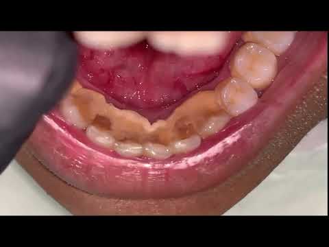 Limpieza de Sarro Dental Supragingival y Subgingival
