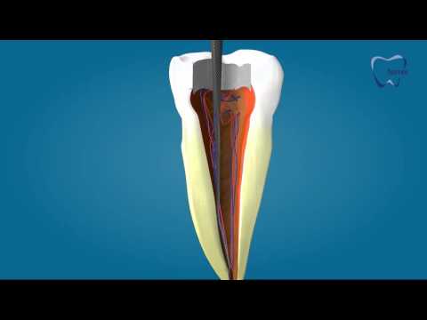 Endodoncia