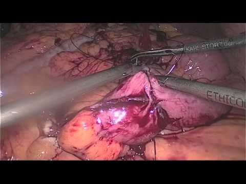 Manchon laparoscopique à dérivation gastrique Roux-en-Y pour sténose persistante de la douille