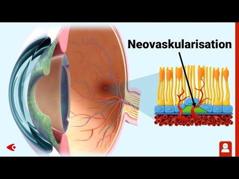Wet macular degeneration: Animation