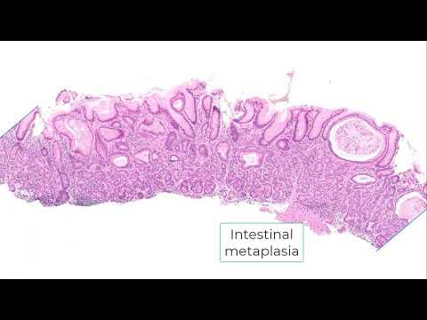Autoimmune gastritis and differential diagnosis