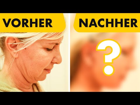 Sie zeigt ihr Facelift 10 Tage nach OP spontan vor der Kamera! Dr. Jungwirth - Plastische Chirurgie