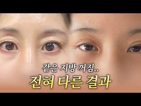 30대와 40대의 눈두덩이 지방 꺼짐.. 결국 수술법까지 달랐다 · 韩语