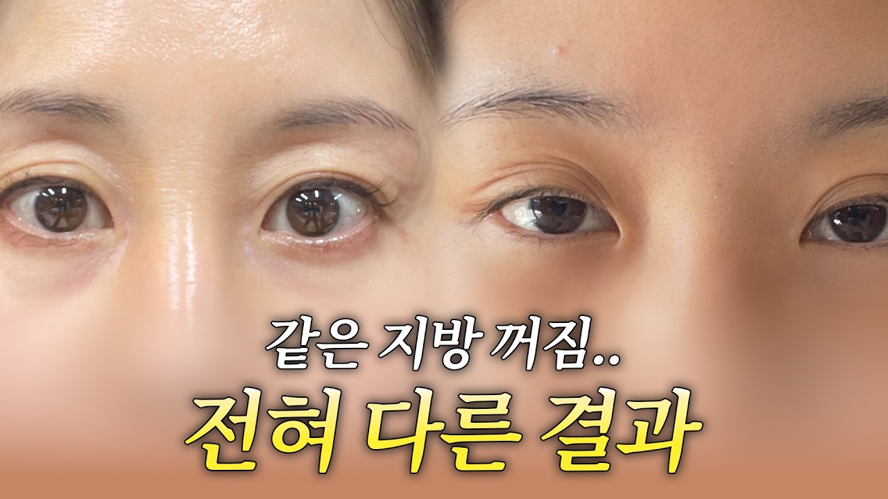 30대와 40대의 눈두덩이 지방 꺼짐.. 결국 수술법까지 달랐다 썸네일 — 마침표성형외과 눈성형 영상