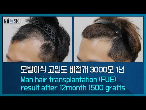 모발이식 고밀도 비절개 3000모 1년 Man hair transplantation (FUE) result after 12month 1500 grafts (뉴헤어)