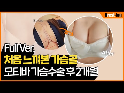 모티바 가슴성형 2개월 후기 I 겨드랑이 절개 흉터 I 가슴 수술 2달차 누웠을 때 모습은? | 윈느성형외과 라벨윈느 유튜브 영상