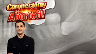 Coronectomy Aborted with Dr. Wahan