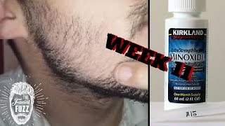 Minoxidil Beard | Week 11 | The Experiment |  #FacialFuzzFridays