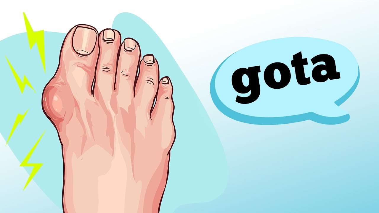 GOTA: QUAIS AS CAUSAS E SINTOMAS?