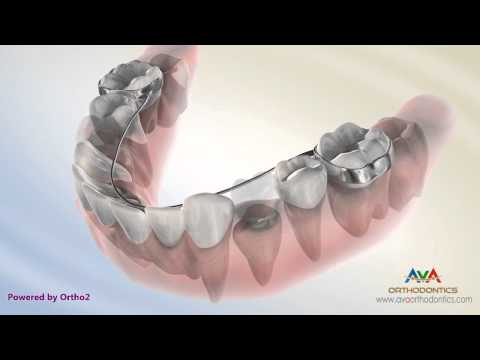 Orthodontic Space Management - Lingual Arch Appliance