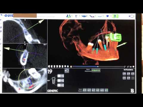 X GUIDE DENTAL IMPLANT SURGERY