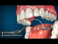 Jaw Surgery for Teeth Alignment - Fixing Jaw Braces