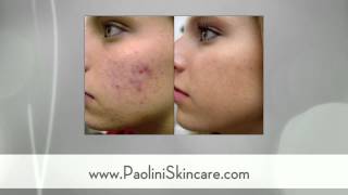 preview picture of video 'Acne Treatment Cape May - Dr. Paolini Dermatologist Cape May Court House'