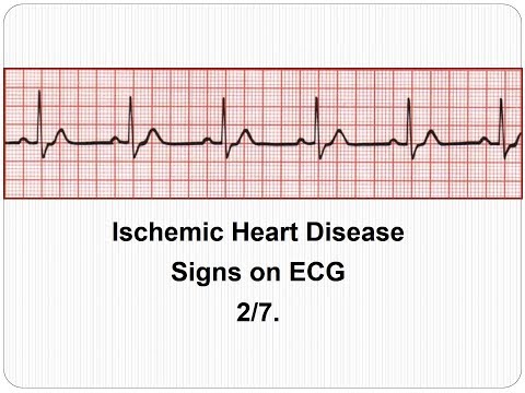 ECG Ischemic Heart Disease 2/7: ECG manifestations