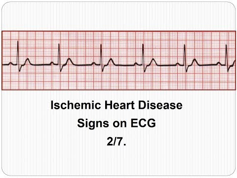 Az EKG meghatározhatja a magas vérnyomást