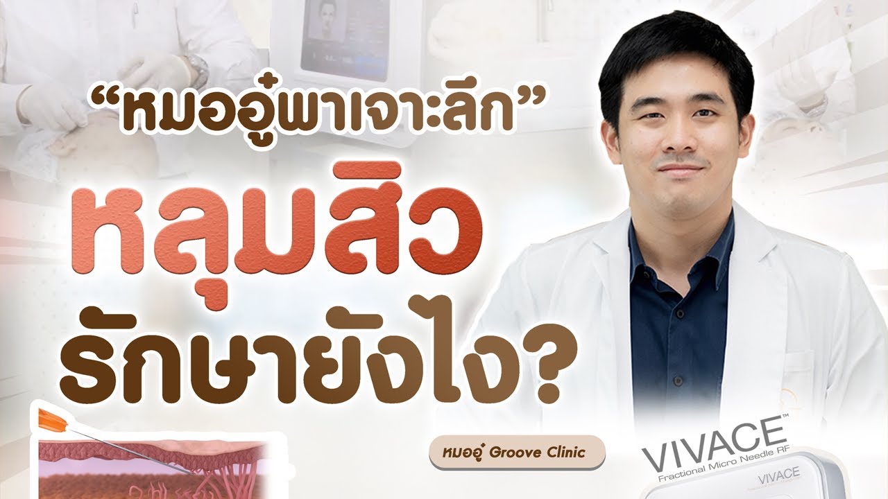 รีวิวรักษาหลุมสิว