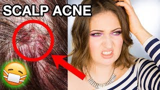 SCALP ACNE & ITCHY DANDRUFF | How To Get Rid of It Completely!