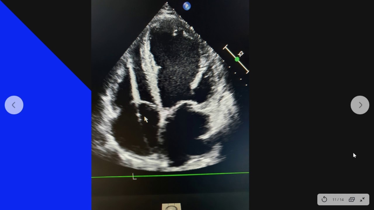 Watch Marcapaso, desfibrilador Now Marcapaso, desfibrilador